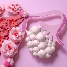 Киста яичника