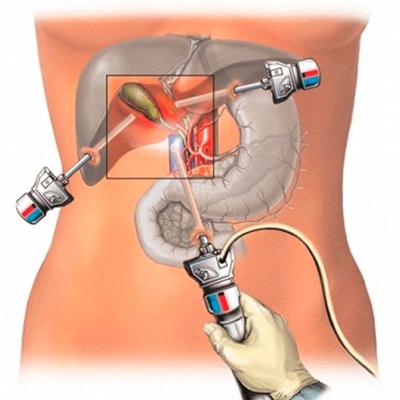 Холецистэктомия из мини-доступа