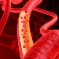 Атеросклероз: причины, симптомы, лечение
