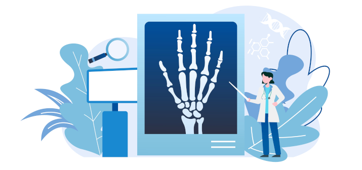 Артроз пальцев