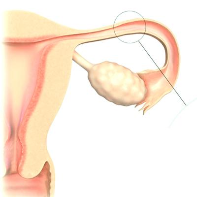 Лапароскопическая сальпингэктомия