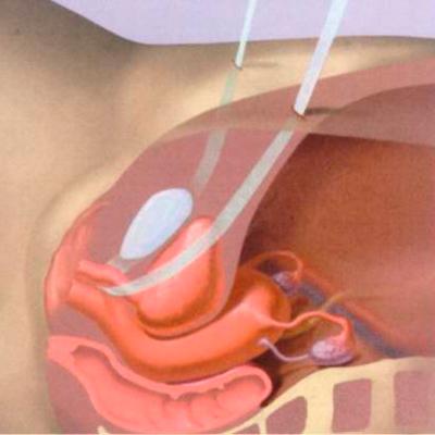 Леваторопластика. Хирургическая коррекция ослабления мышц тазового дна