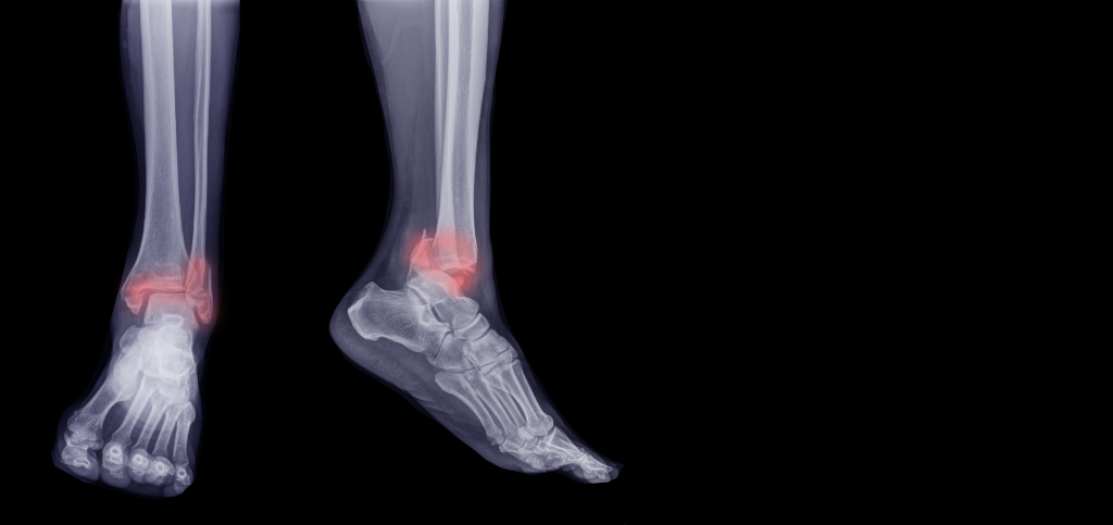 Рентгенография голеностопного сустава