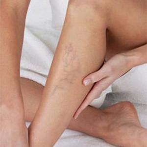 Варикоз: заблуждения и реальность