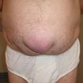 Грыжа белой линии живота