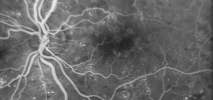 Флюоресцентная ангиография сетчатки (ФАГ)