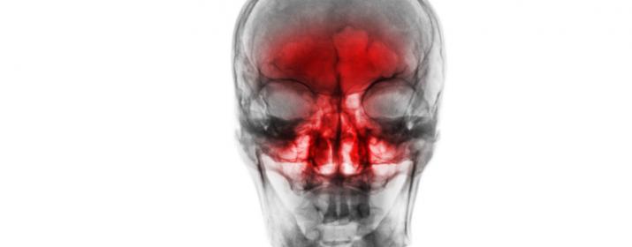 Рентгенография придаточных пазух носа