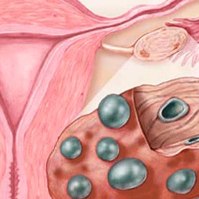 СПКЯ (синдром поликистозных яичников)