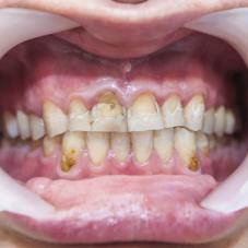 Болезни эмали зубов