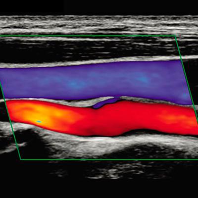 Дуплексное сканирование: особенности диагностики сосудов