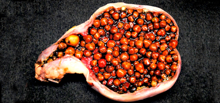 Причины образования камней в желчном пузыре