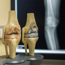 Эндопротезирование коленного сустава