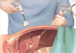 Лапароскопия при бесплодии