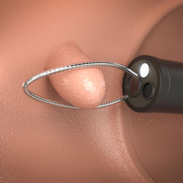 Удаление полипов анального канала