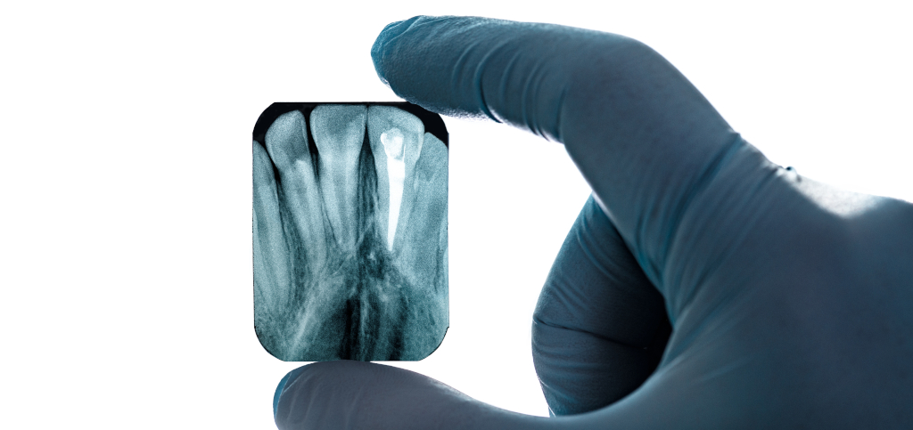 Рентгеновский снимок зуба