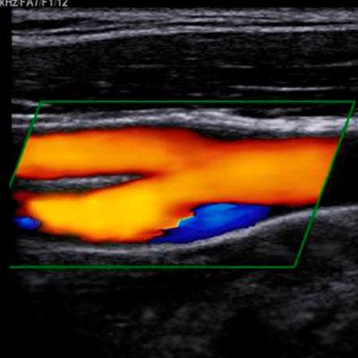 Цветное дуплексное сканирование