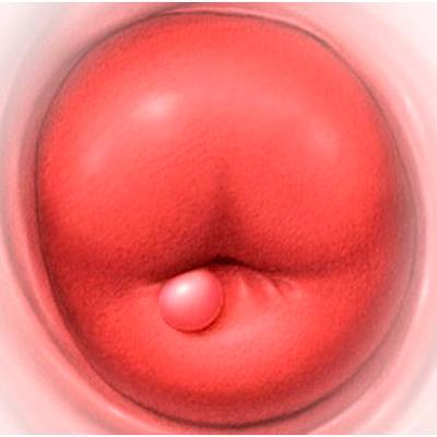 Киста шейки матки (наботовы кисты)