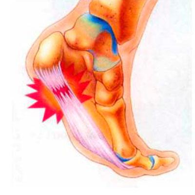 Пяточная шпора, теннисный локоть, артроз, деформация пальцев стопы