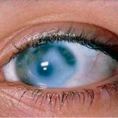 Глаукома: симптомы и лечение