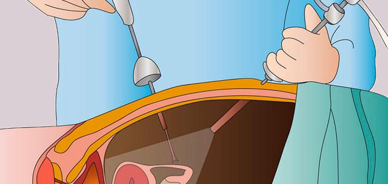 Лапароскопическое лечение паховых грыж