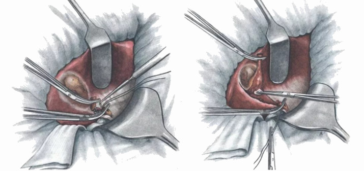 Открытая холецистэктомия 
