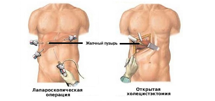 Камни в желчном пузыре: варианты лечения