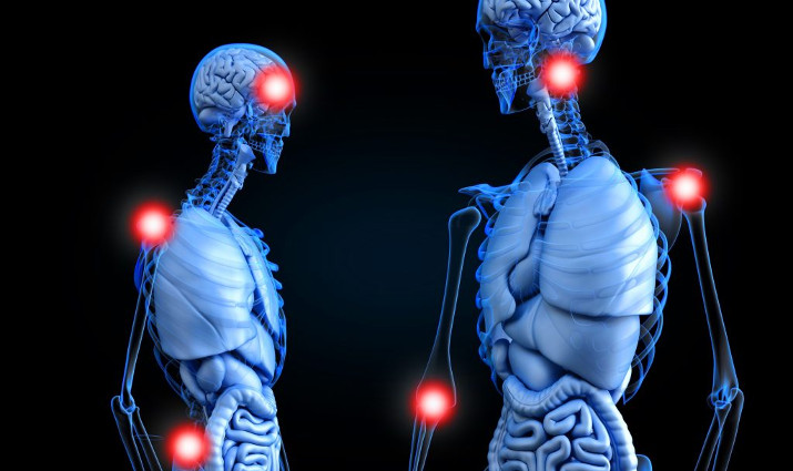 Миофасциальный болевой синдром