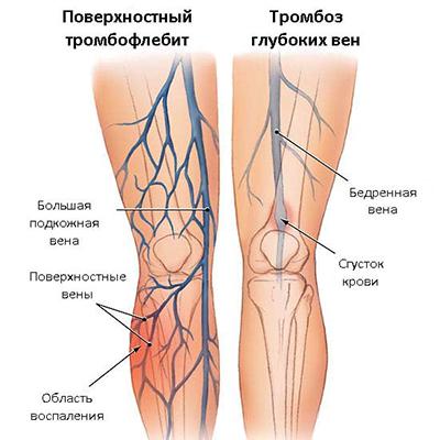 Что такое тромбофлебит и как его лечить