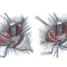 Открытая холецистэктомия 