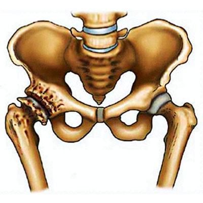 Коксартроз: деформирующий артроз тазобедренного сустава