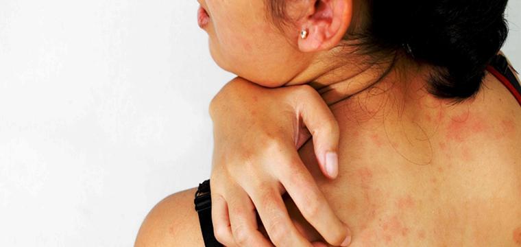 Крапивница и отек Квинке