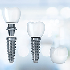 Имплантация зубов «под ключ»