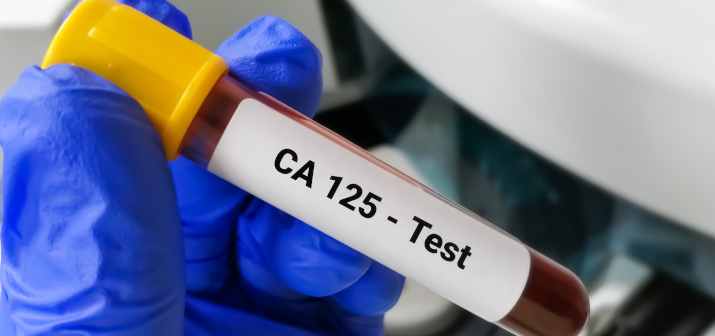 Онкомаркеры рака молочной железы