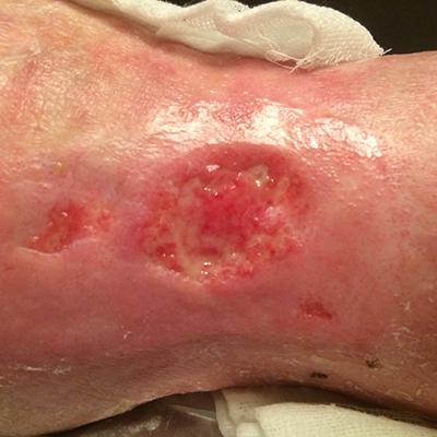 Трофическая язва: осложнения и лечение заболевания