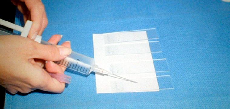 Дайджен-тест (Digene test): метод диагностики ВПЧ