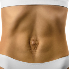 Диастаз прямых мышц живота