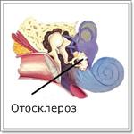 Отосклероз