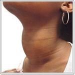 заболевания щитовидной железы