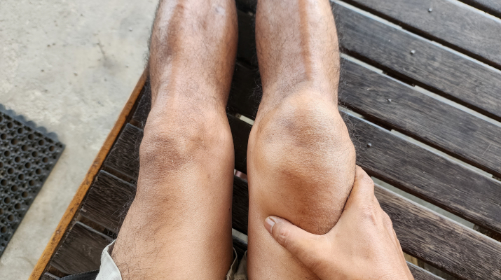 Вывих коленного сустава