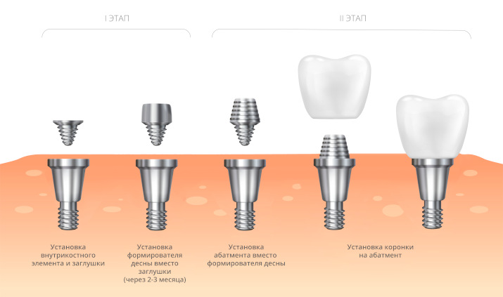 Этапы протезирования Этапы протезирования
