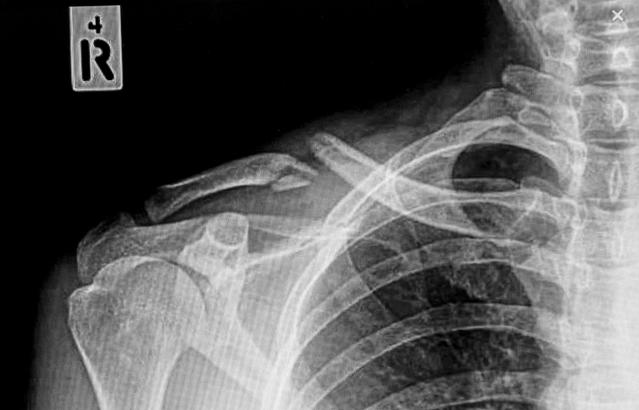 Перелом ключицы