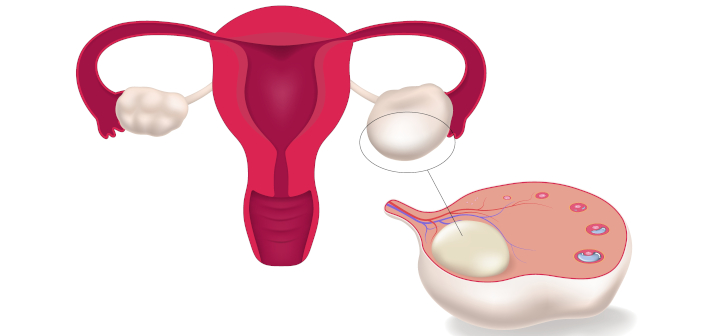 Киста яичника
