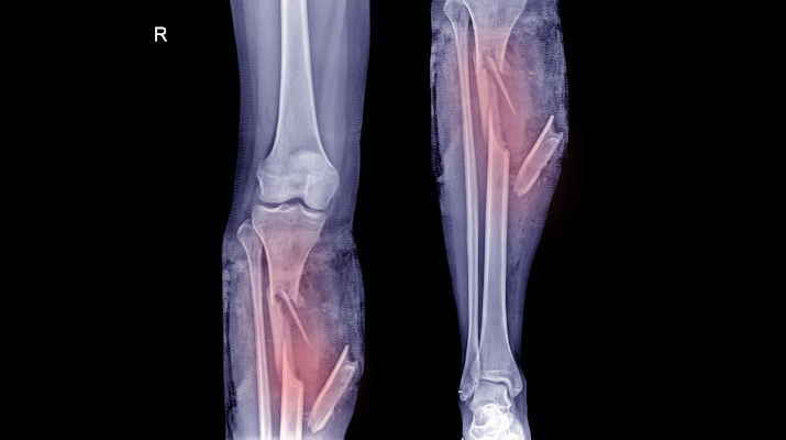 Перелом голени