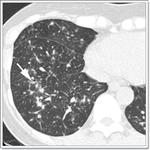 септопластика