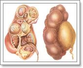 гидронефроз почки