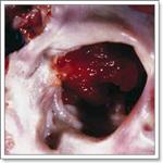 опухоли женских половых органов