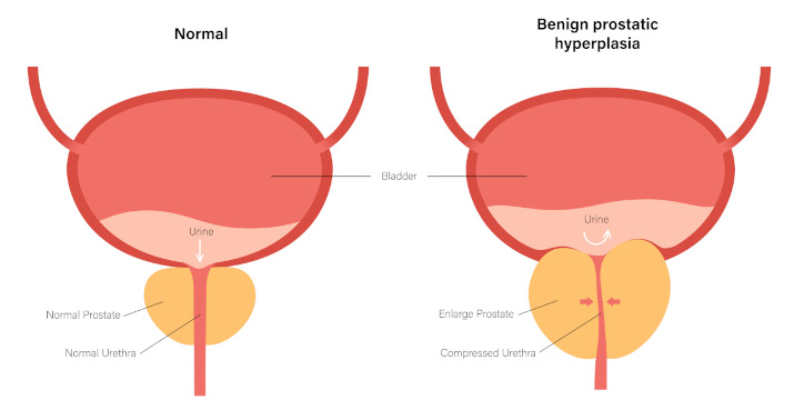 Доброкачественная гиперплазия предстательной железы