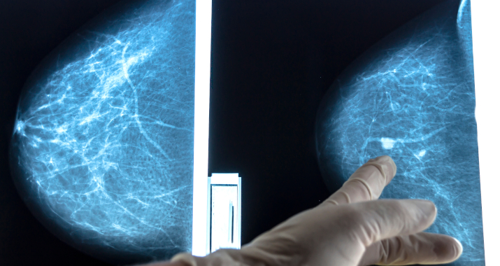 Киста на маммографии