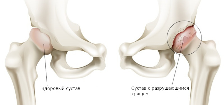 Коксартроз