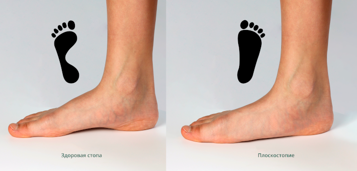 Плоскостопие Плоскостопие